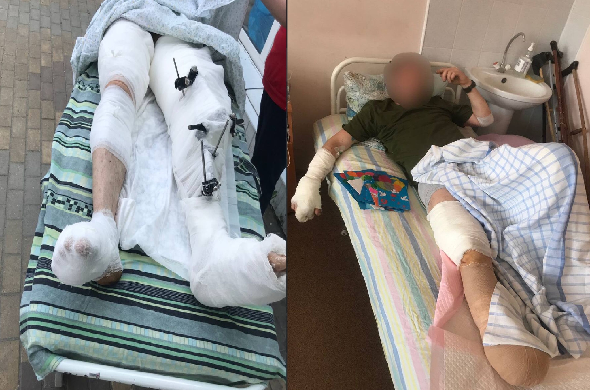 A military serviceman whose limbs were saved by doctors, and a serviceman with an amputated foot