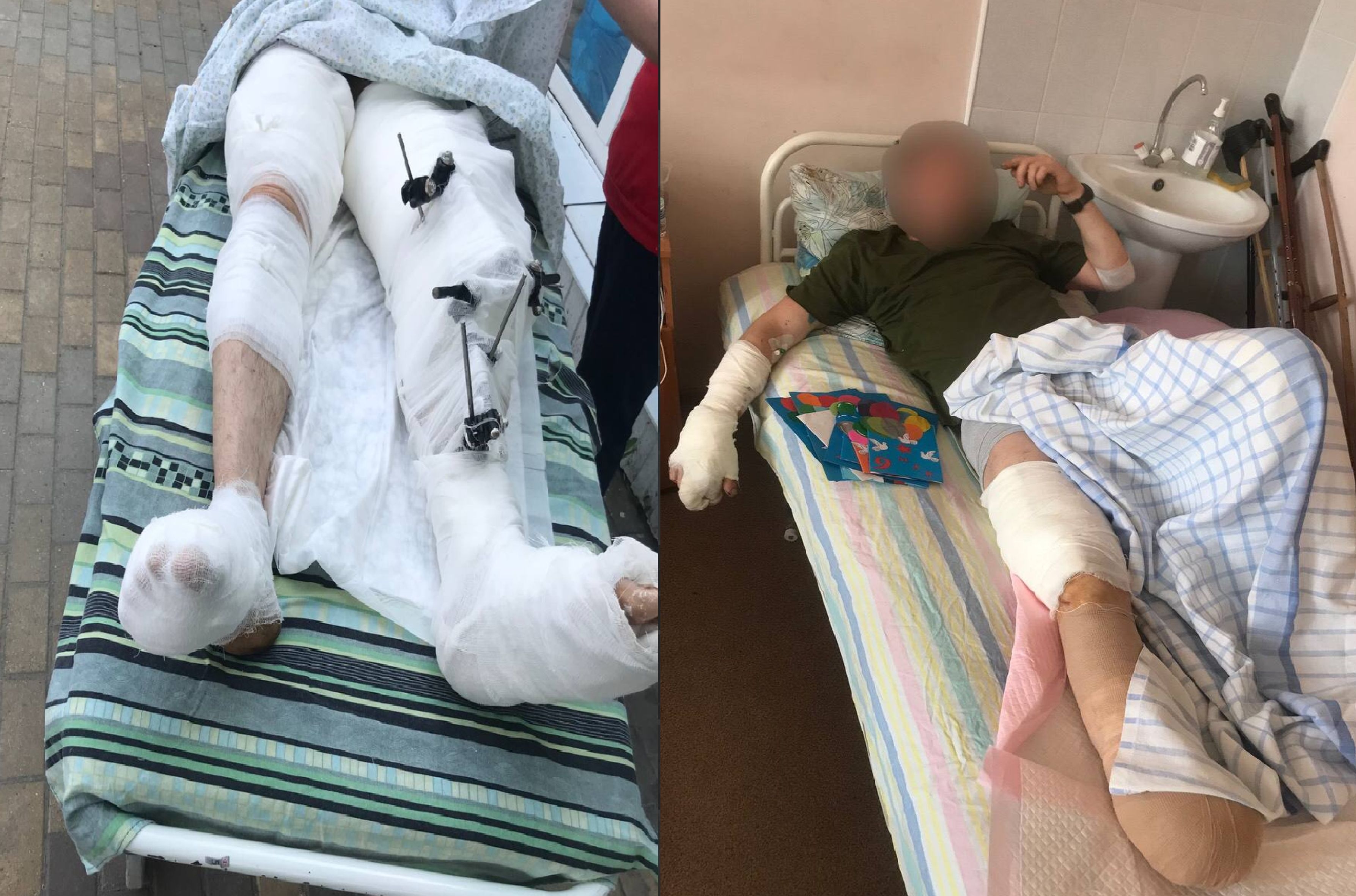 A military serviceman whose limbs were saved by doctors, and a serviceman with an amputated foot