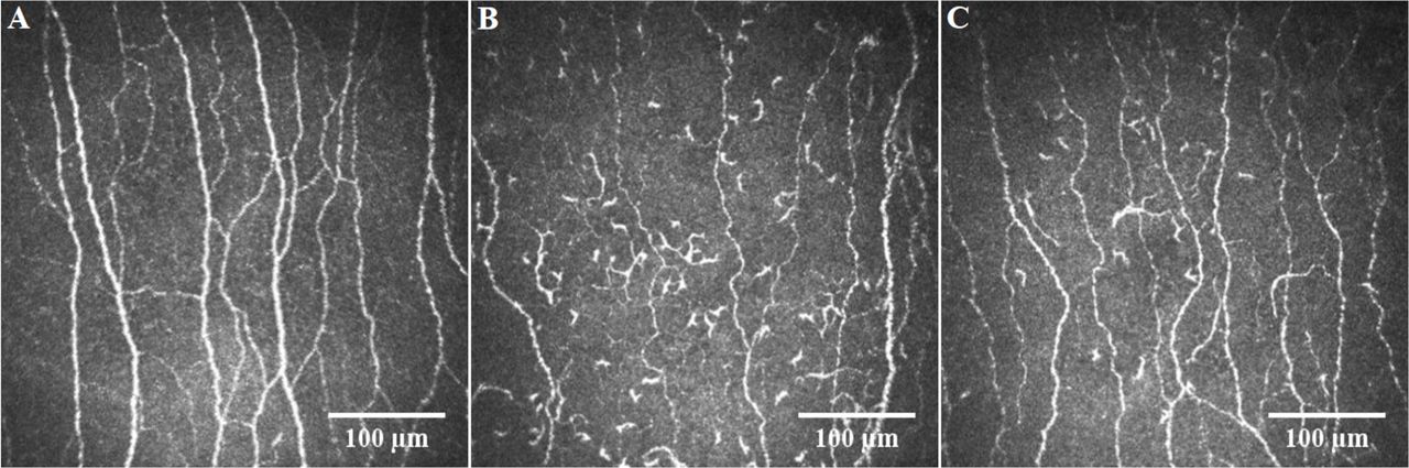 Representative corneal confocal microscopic images of the central corneal sub-basal nerve plexus in a healthy control participant (A), and in COVID-19 patients with (B) and without (C) long COVID